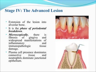 Stage IV: The Advanced Lesion
• Extension of the lesion into
alveolar bone.
• It is the phase of periodontal
breakdown.
• Microscopically, there is
fibrosis of gingiva and
widespread manifestations of
inflammatory and
immunopathologic tissue
damage.
• Plasma cell presence dominates
connective tissue and
neutrophils dominate junctional
epithelium.
 