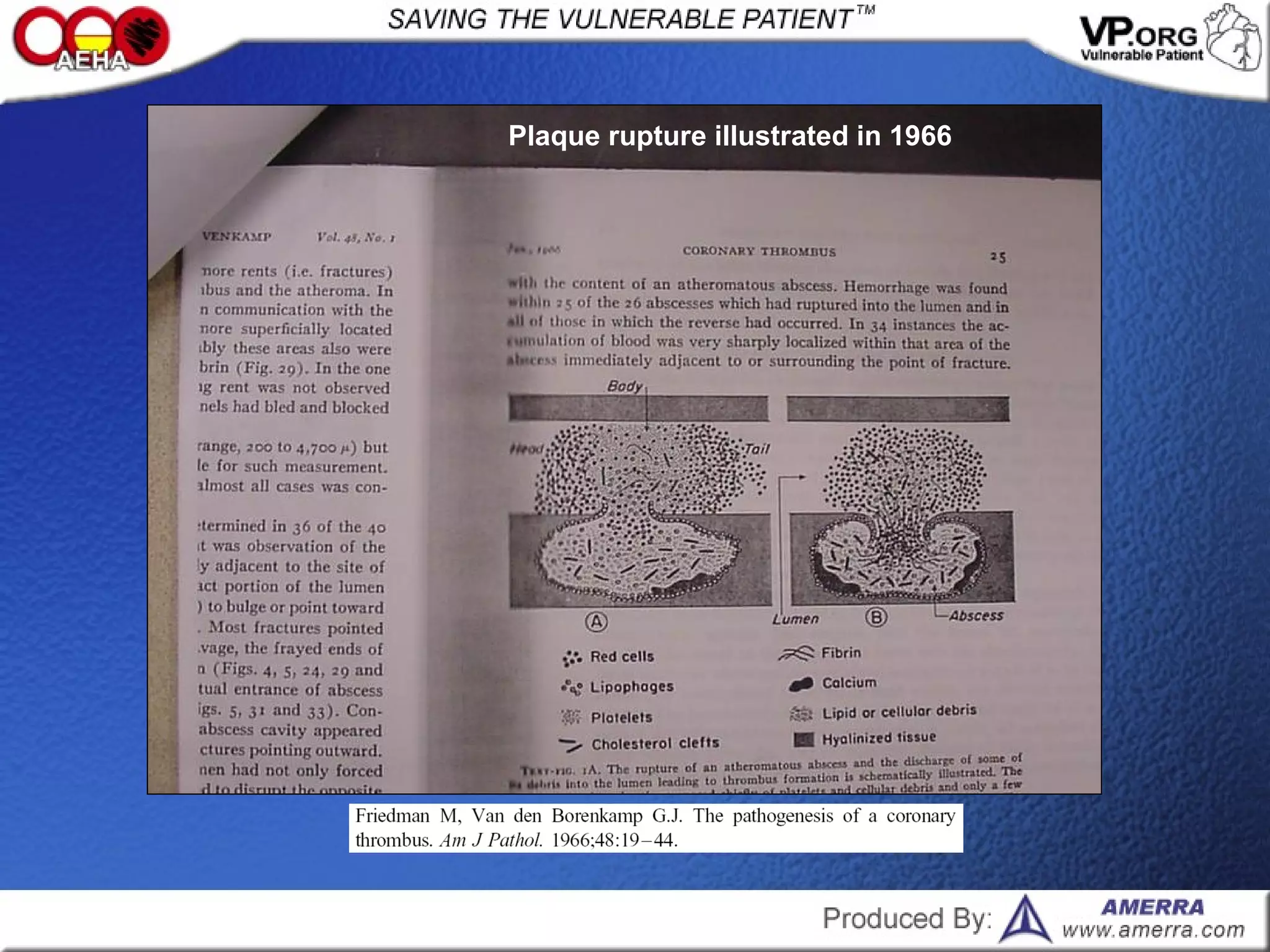 Plaque rupture illustrated in 1966
 