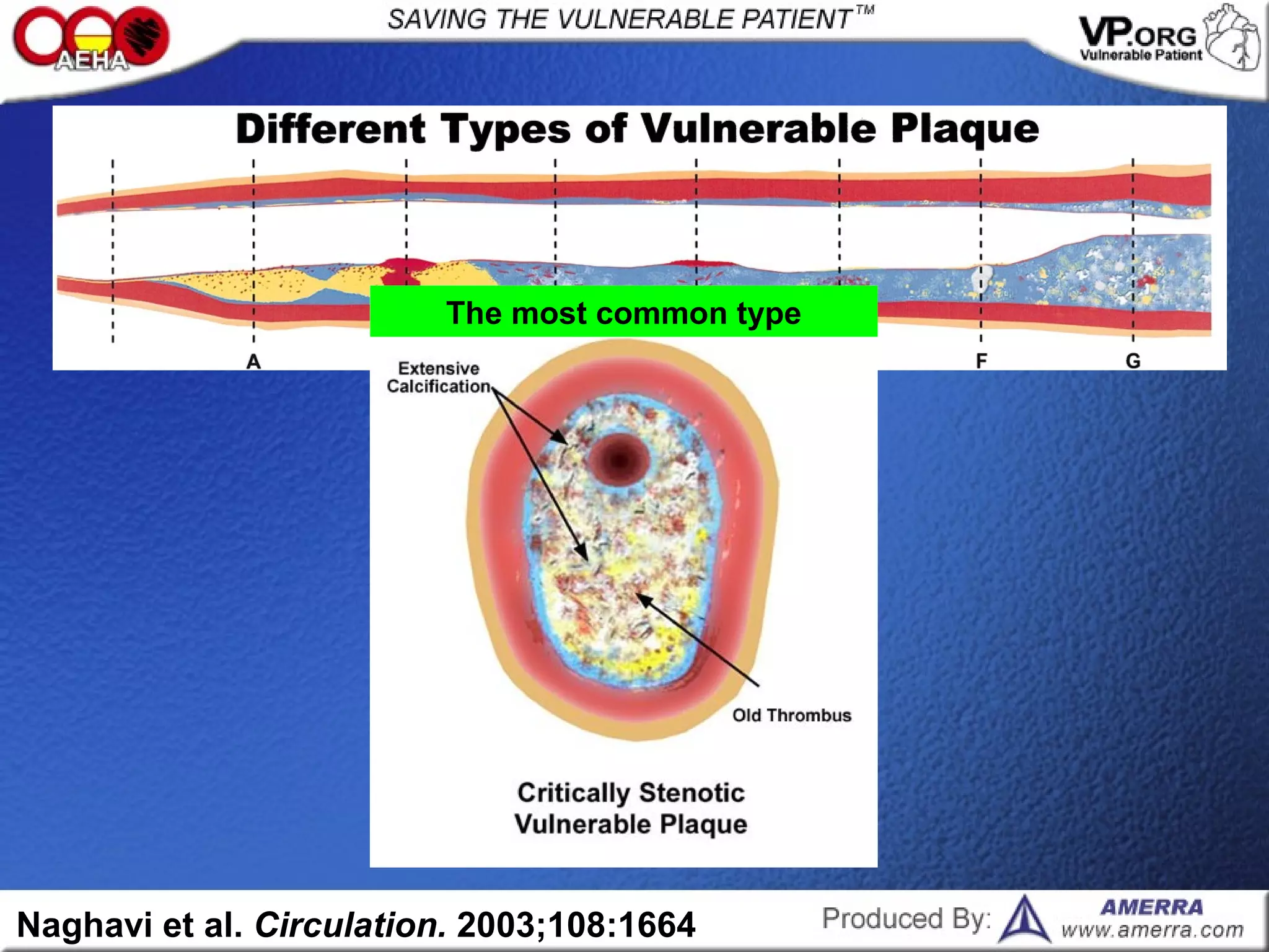 Naghavi et al. Circulation. 2003;108:1664
The most common type
 