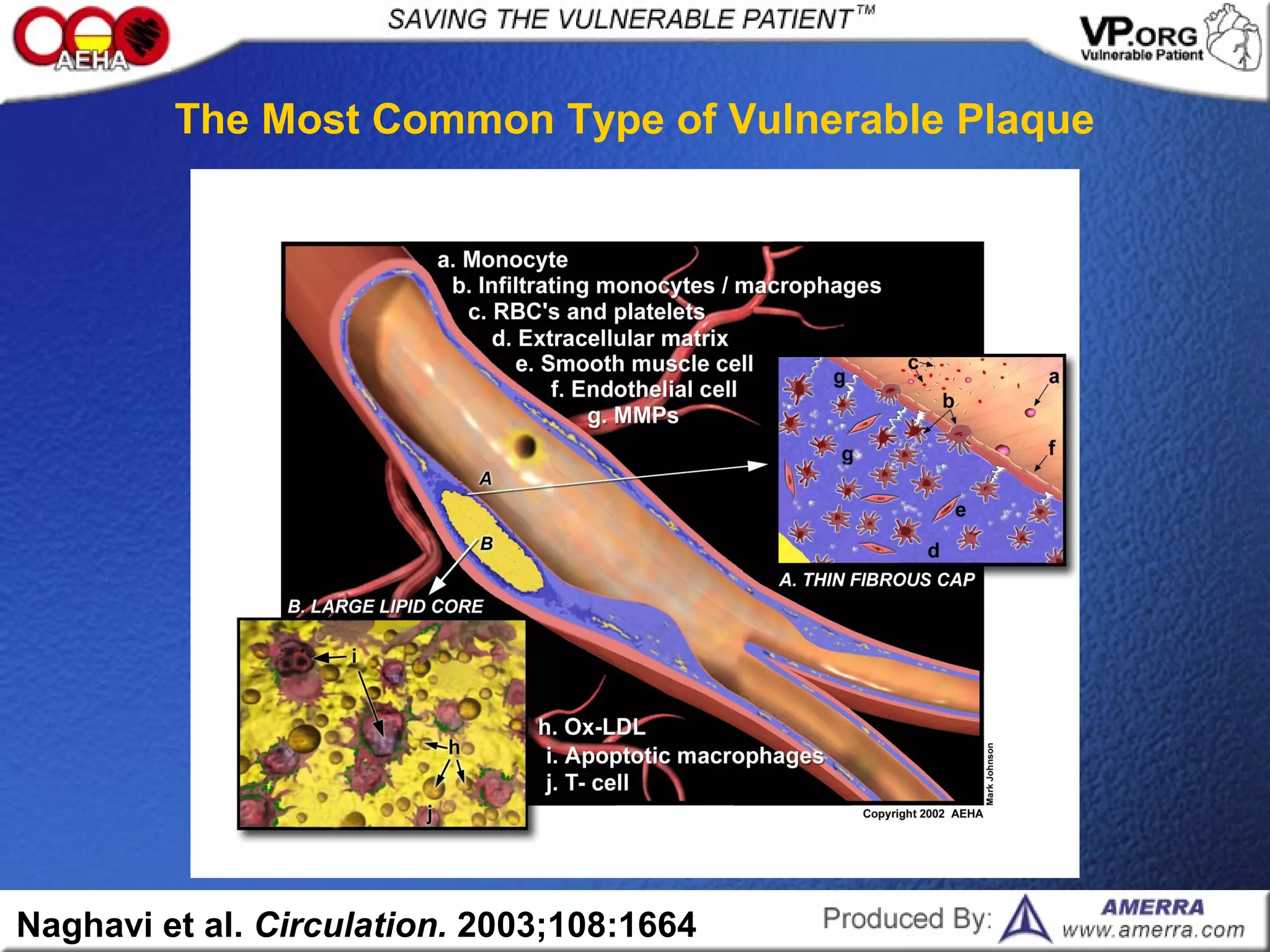 Naghavi et al. Circulation. 2003;108:1664
The Most Common Type of Vulnerable Plaque
 