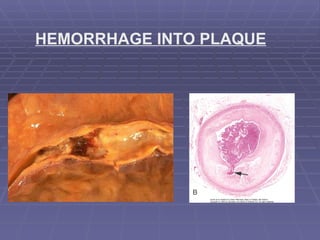HEMORRHAGE INTO PLAQUE 