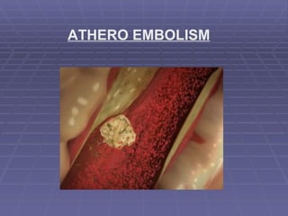 ATHERO EMBOLISM 