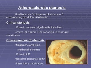 Atherosclerotic stenosis Small arteries    plaques occlude lumen    compromising blood flow   ischemia. Critical stenosis Chronic occlusion significantly limits flow . occurs  at approx 70% occlusion in coronary  circulation . Consequences of stenosis Mesenteric occlusion  and bowel ischemia. Chronic IHD. Ischemic encephalopathy. Intermittent claudication.  