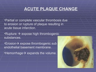 ACUTE PLAQUE CHANGE Partial or complete vascular thrombosis due to erosion or rupture of plaque resulting in acute tissue infarction. Rupture    expose high thrombogenic substances. Erosion   expose thrombogenic sub endothelial basement membrane. Hemorrhage   expands the volume. 