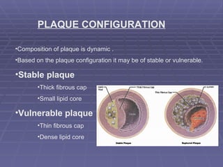 PLAQUE CONFIGURATION Composition of plaque is dynamic . Based on the plaque configuration it may be of stable or vulnerable. Stable plaque Thick fibrous cap Small lipid core Vulnerable plaque Thin fibrous cap Dense lipid core 