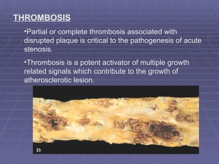 THROMBOSIS Partial or complete thrombosis associated with disrupted plaque is critical to the pathogenesis of acute stenosis. Thrombosis is a potent activator of multiple growth related signals which contribute to the growth of atherosclerotic lesion. 