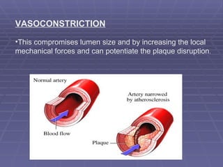 VASOCONSTRICTION This compromises lumen size and by increasing the local mechanical forces and can potentiate the plaque disruption .  