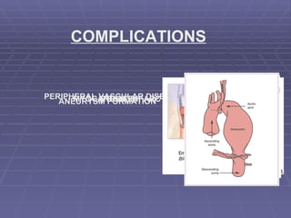 COMPLICATIONS MYOCARDIAL INFARCTION STROKE PERIPHERAL VASCULAR DISEASE ANEURYSM FORMATION 