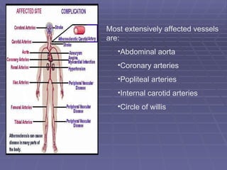 Most extensively affected vessels are: Abdominal aorta  Coronary arteries  Popliteal arteries Internal carotid arteries Circle of willis 