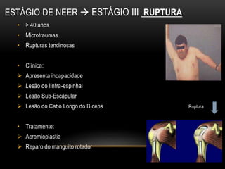 ESTÁGIO DE NEER  ESTÁGIO III RUPTURA
• > 40 anos
• Microtraumas
• Rupturas tendinosas
• Clínica:
 Apresenta incapacidade
 Lesão do Iinfra-espinhal
 Lesão Sub-Escápular
 Lesão do Cabo Longo do Bíceps Ruptura
• Tratamento:
 Acromioplastia
 Reparo do manguito rotador
 