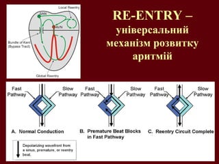 RE-ENTRY –
універсальний
механізм розвитку
аритмій
 
