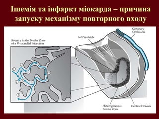 Ішемія та інфаркт міокарда – причина
запуску механізму повторного входу
 