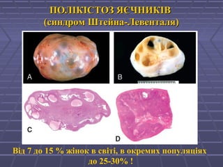 ПОЛІКІСТОЗ ЯЄЧНИКІВПОЛІКІСТОЗ ЯЄЧНИКІВ
(синдром Штейна-Левенталя)(синдром Штейна-Левенталя)
Від 7 до 15 % жінок в світі, в окремих популяціях
до 25-30% !
 