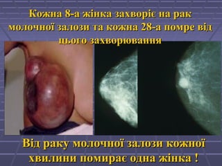 Від раку молочної залози кожноїВід раку молочної залози кожної
хвилини помирає одна жінка !хвилини помирає одна жінка !
Кожна 8-а жінка захворіє на ракКожна 8-а жінка захворіє на рак
молочної залози та кожна 28-а помре відмолочної залози та кожна 28-а помре від
цього захворюванняцього захворювання
 