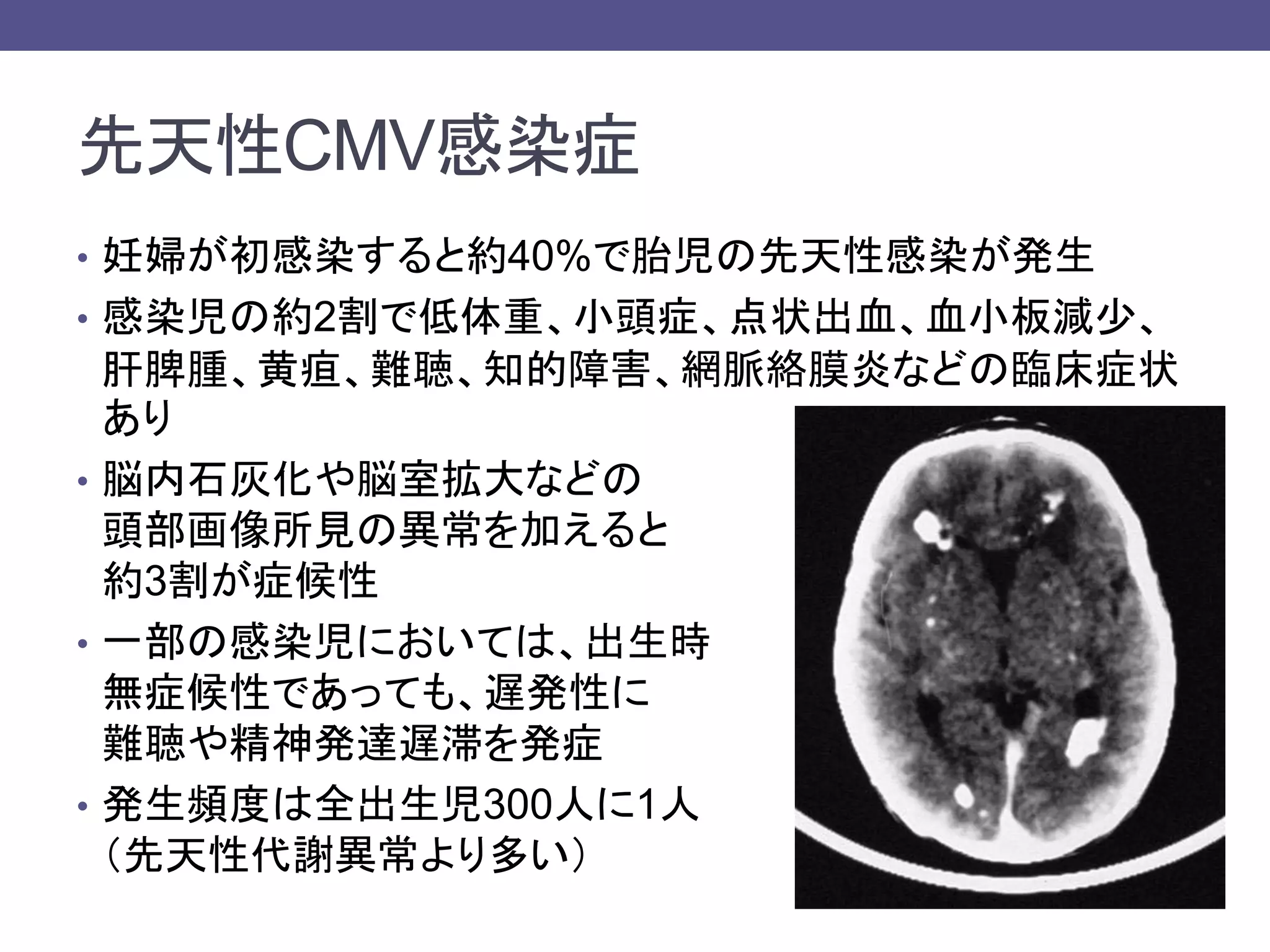 先天性CMV感染症
• 妊婦が初感染すると約40%で胎児の先天性感染が発生
• 感染児の約2割で低体重、小頭症、点状出血、血小板減少、
肝脾腫、黄疸、難聴、知的障害、網脈絡膜炎などの臨床症状
あり
• 脳内石灰化や脳室拡大などの
頭部画像所見の異常を加えると
約3割が症候性
• 一部の感染児においては、出生時
無症候性であっても、遅発性に
難聴や精神発達遅滞を発症
• 発生頻度は全出生児300人に1人
（先天性代謝異常より多い）
 