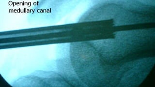 Distal Femur retrograde nailing 