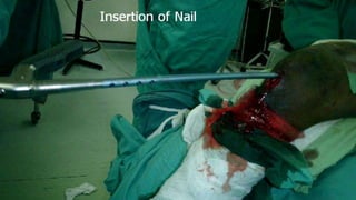 Distal Femur retrograde nailing 