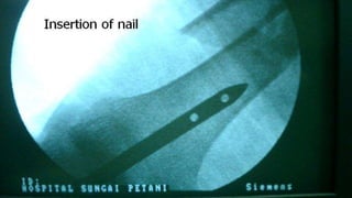Distal Femur retrograde nailing 