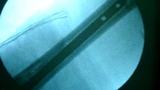 Distal Femur retrograde nailing 