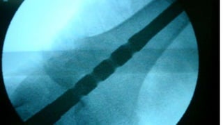 Distal Femur retrograde nailing 