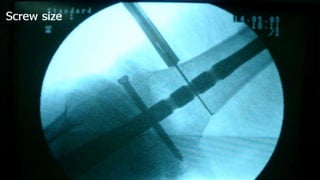 Distal Femur retrograde nailing 