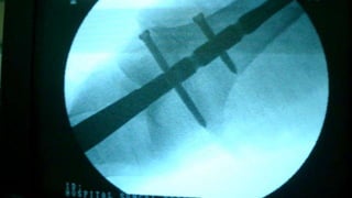 Distal Femur retrograde nailing 