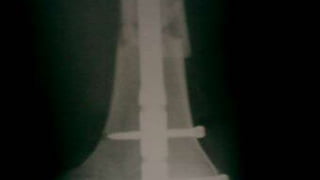 Distal Femur retrograde nailing 