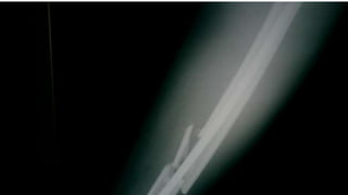 Distal Femur retrograde nailing 