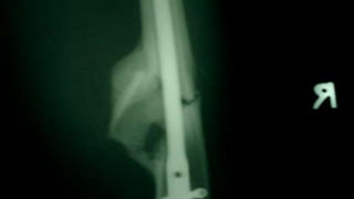 Distal Femur retrograde nailing 