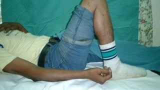 Distal Femur retrograde nailing 