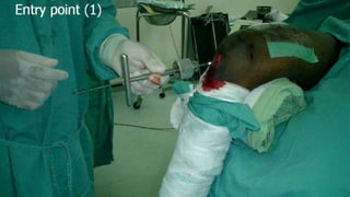 Distal Femur retrograde nailing 