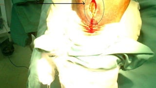 Distal Femur retrograde nailing 