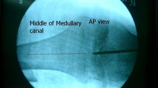 Distal Femur retrograde nailing 