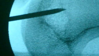 Distal Femur retrograde nailing 