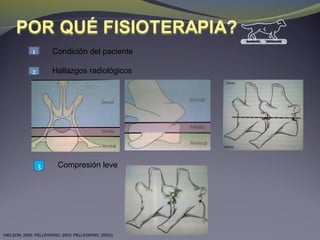 1 Condición del paciente
Hallazgos radiológicos2
3 Compresión leve
(NELSON, 2000; PELLEGRINO, 2003: PELLEGRINO, 2003))
 