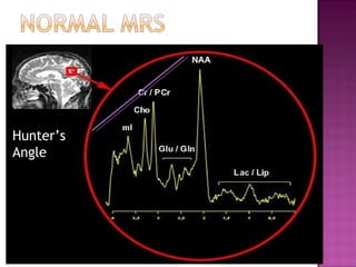 Imaging modalities in Cerebral Glioma | PPT