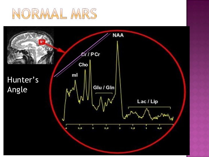 Imaging modalities in Cerebral Glioma