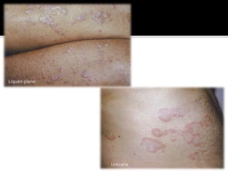 Palparlas y frotarlas.