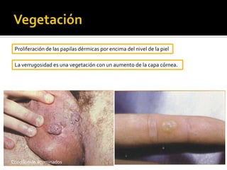 Palpación: Profundidad, textura, extensión, fijación a estructuras.LESIONES ELEMENTALESSe clasifican en:Primarias: Cuando aparecen sobre piel sana.