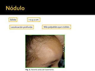 Secundarias: Cuando asientan sobre piel previamente lesionada.