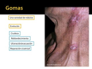 MáculaCambio de coloración sin que haya alteraciones en el relieve, depresión, espesor ni consistenciaAlteraciones  a nivel vascular cutáneo o por depósitos de sustancias pigmentarias en la epidermis o en la dermisMáculas pigmentariasMáculas vasculares ExantemaCuando el eritema cubre grandes zonas de pielMorbiliformeEscarlatiniformeEnantemaLocalización mucosa del exantema 