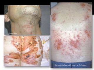 Liquen planoUrticaria