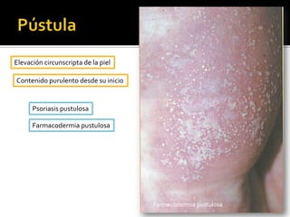 PlacaSimilar a la pápula pero de tamaño mayor de 0.5 – 1 cm y con infiltración.Erisipela