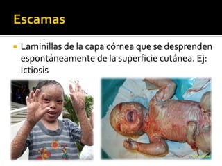 VegetaciónProliferación de las papilas dérmicas por encima del nivel de la piel La verrugosidad es una vegetación con un aumento de la capa córnea.Condilomas acuminados