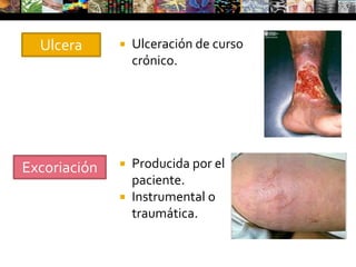 Carcinoma basocelularQuiste epidérmico en la frente