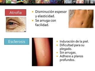 VesículaCavidad de contenido líquido Seroso, hemorrágico o purulento< 5 mmMultitabicadas y situadas en la epidermisMecanismo de formaciónEspongiosisEdema intercelular. Ej: EccemaLas células se hinchan y se separan unas de otras. Ej: Herpes zosterDegeneración balonizante y reticular