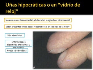 UlceraUlceración de curso crónico.