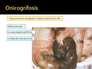 Dificultad para su plegado.
