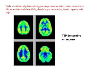 Cada una de las siguientes imágenes representa cuatro cortes coronales a
distintas alturas del encéfalo, desde la parte superior, hasta la parte más
baja




                                                     TEP de cerebro
                                                     en reposo
 