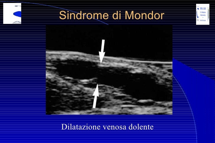 Malattia varicosa di metodo di trattamento di gambe